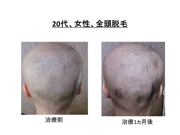 円形脱毛症　病院""